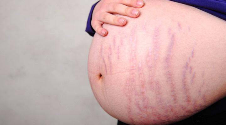 remove stretch marks, how to remove stretch marks, after pregnancy stretch marks, stretch marks on stomach