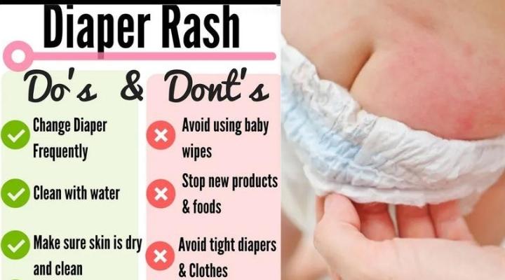 Tips about diapering, How to cure from rashes, Baby diaper rashes, Must know tips about diapering- Every Parent should know