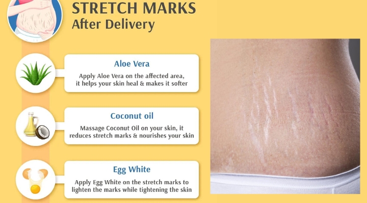 How to remove stretch marks on breast, types of stretch marks on breast, How to get rid off stretch marks on breast, Stretch marks on breast after pregnancy